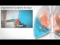 Pleural Effusion Animation
