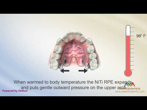 Orthodontic Expander or Spacer - NiTi Palatal Bar Appliance