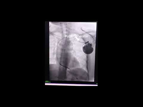 Purpose of an Automated Implantable Cardioverter Defibrillator