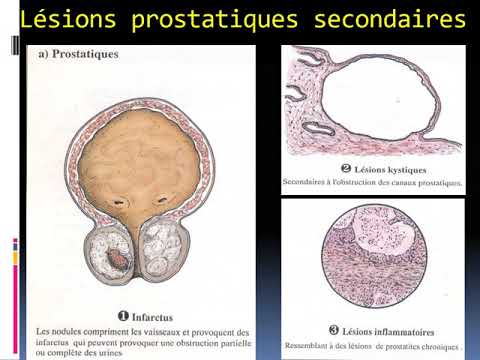 Diagnosticul pcr pentru prostatită