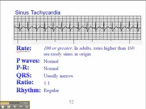 sinus tachycardia magas vérnyomás