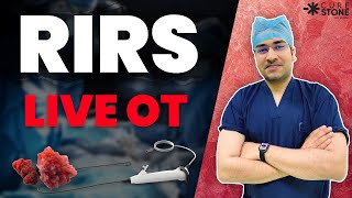 How RIRS Laser Surgery Works — Complete Guide
