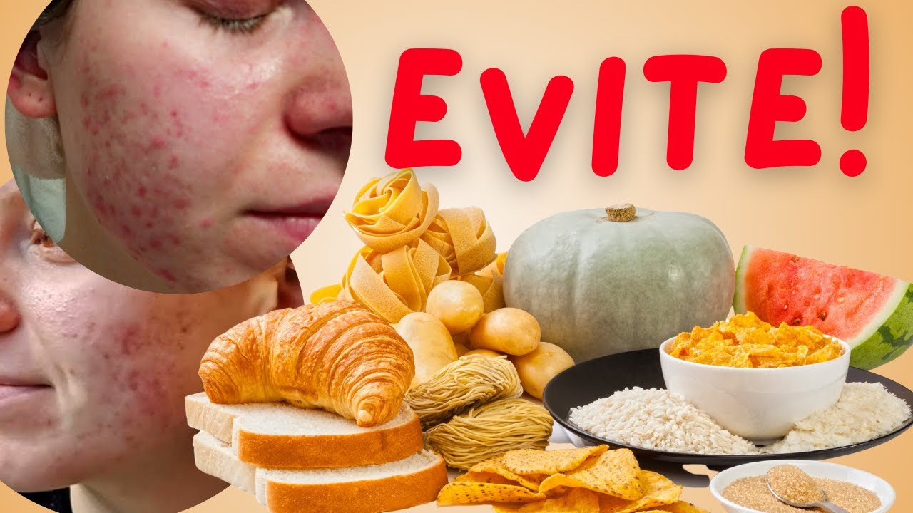 Os PIORES alimentos para quem tem ACNE 🍫