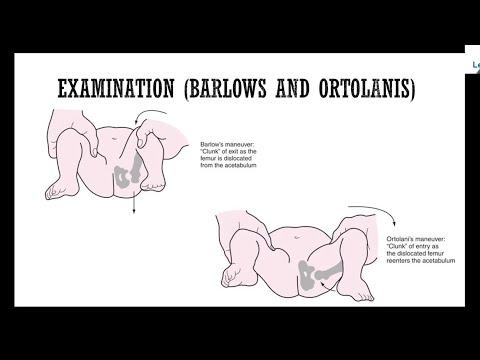 Developmental Dysplasia of Hip for FRCS Orth