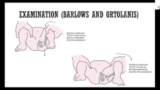 Developmental Dysplasia of Hip for FRCS Orth