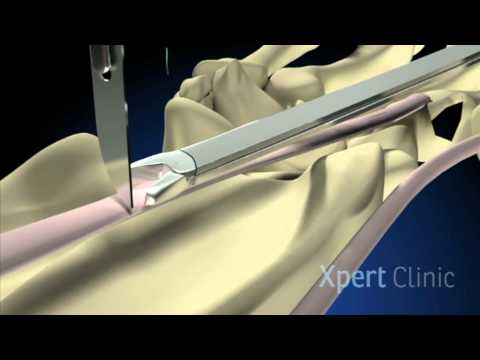 Operatie Duimbasis artrose (Duimbasisslijtage)