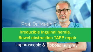 Miniaturka - Irreducible Inguinal hernia & Bowel obstruction. TAPP Repair. Metin Ertem MD.FACS