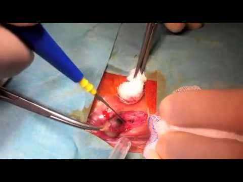 download lagu mp3 mp4 Lancing A Thrombosed Hemorrhoid, download lagu Lancing A Thrombosed Hemorrhoid gratis, unduh video klip Lancing A Thrombosed Hemorrhoid