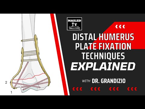Distal Humerus Plate Fixation Techniques EXPLAINED