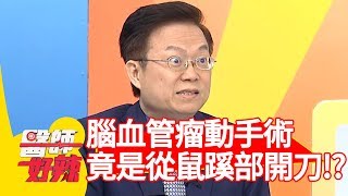 驚！腦血管瘤動手術！竟是從「鼠蹊部」開刀？！【醫師好辣】 20190218  part3 EP690侯昌明 洪永祥