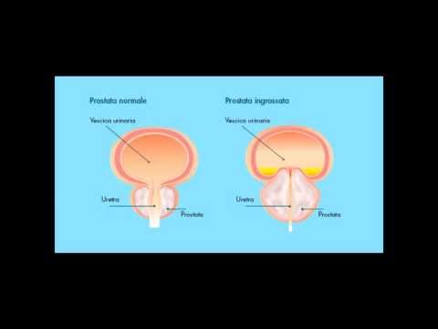 Candele vitaprost prevenzione La salute della prostata siberiano