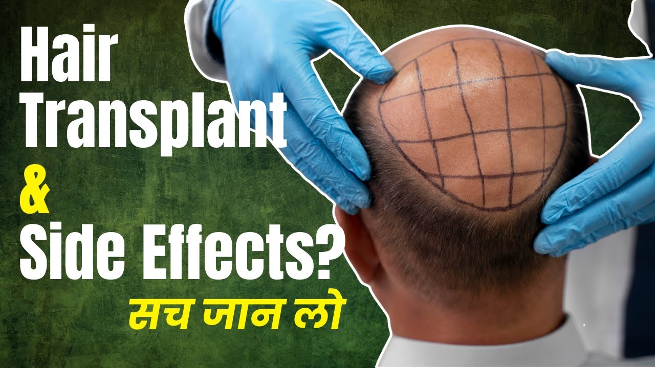 Hair Transplant Side Effects Dr Kashish Kalra Explains