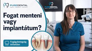 Fogmegtartás vagy implantátum?