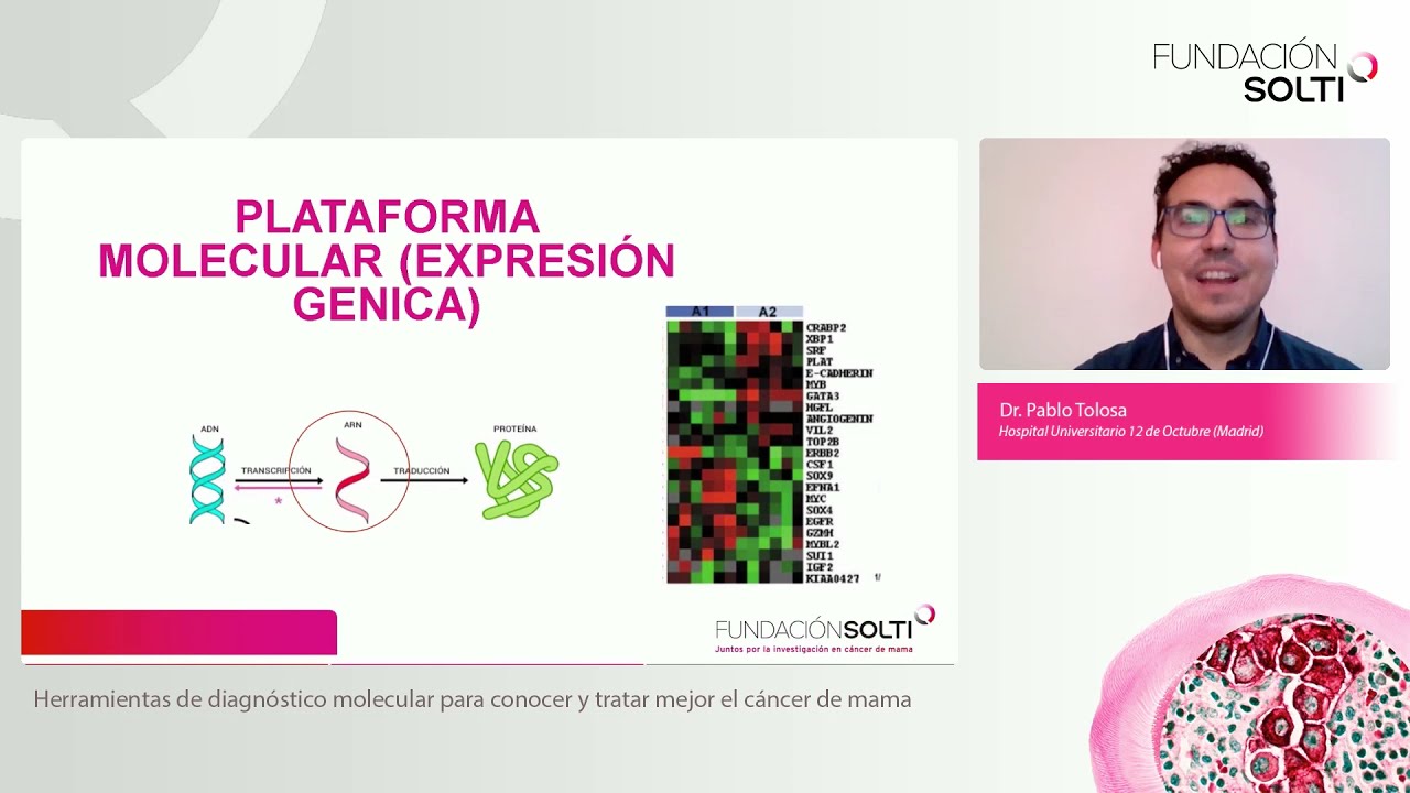 Herramientas de diagnóstico molecular para conocer y tratar mejor el cáncer de mama