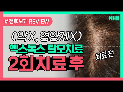 엑스톡스 단독 탈모치료 2회 치료 전후ㅣ전후보기reviewㅣ뉴헤어