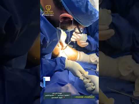 تجربة ناجحة لعملية اعادة بناء الرباط الصليبي الامامي