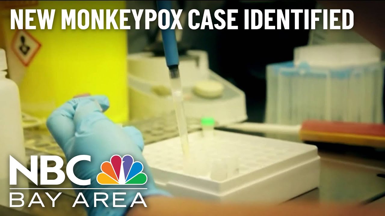 Probable Monkeypox Infection Reported in Santa Clara County