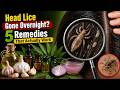 Top 5 Home Remedies To Get Rid Of Head LICE Nits Sushmita S Diaries