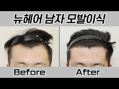 남자 모발이식 1700모낭(3400모) 360일 경과 I 헤어라인 I 모발이식 I 뉴헤어 I Before&After