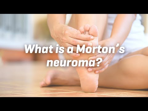 What is a Morton’s neuroma?