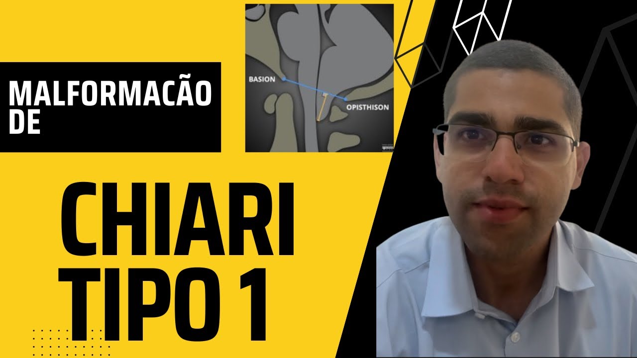 MALFORMAÇÃO DE CHIARI TIPO 1