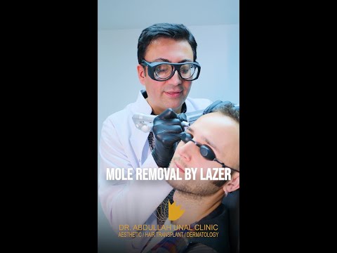 Ağrı, sızı, kesi, dikiş olmadan iz kalmadan lazer ile konforlu ben alımı.