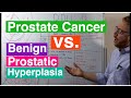 Benign Prostatic Hyperplasia vs Prostate Cancer