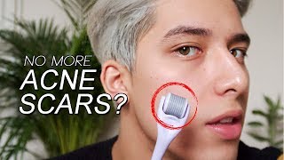 NEEDLING My ACNE SCARS | Before + After