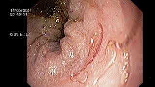 Numerous hookworms in duodenum causing severe anemia with Hb 1.8 g%