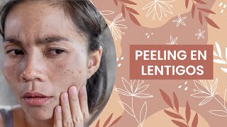 PEELING EN LENTIGOS dermalia cosmetologia aparatologia