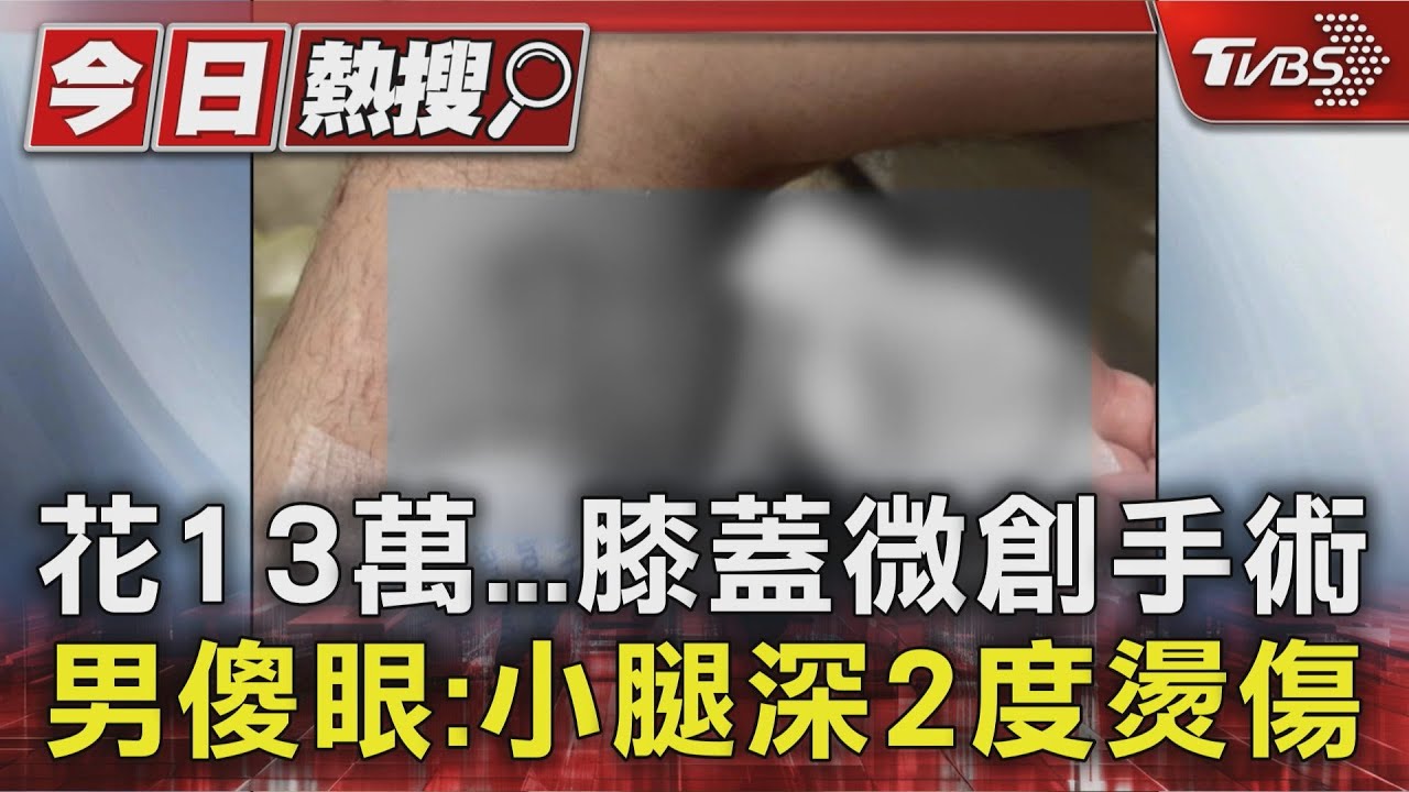 膝蓋微創手術花13萬 男傻眼:結果小腿深二度燙傷