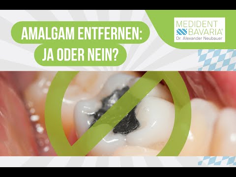Amalgam entfernen: Ja oder Nein?