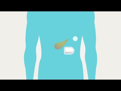 Omnipod® - Basal & Bolus Therapy