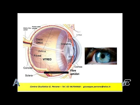 ANGOLI 22/3/2022: LENTI INTRAOCULARI - APPROFONDIMENTO CON IL PROF. GIUSEPPE PERONE
