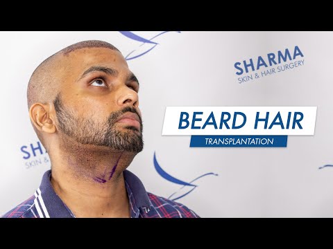 Beard to Scalp Hair Transplant