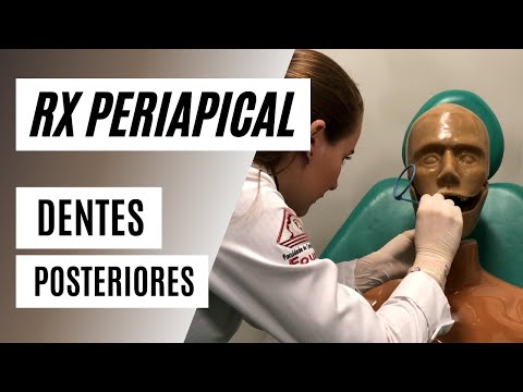 How to radiograph posterior teeth with a positioner | Periapical technique