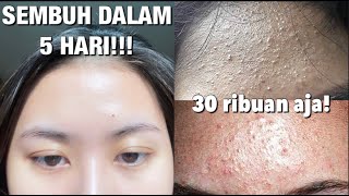 Download lagu Skincare Routine Untuk Kulit Bruntusan/Fungal Acne mp3