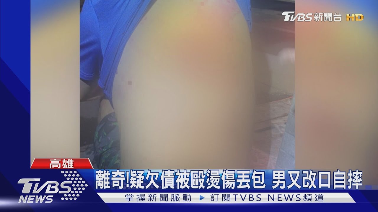 離奇!疑欠債被毆燙傷丟包 男又改口自摔