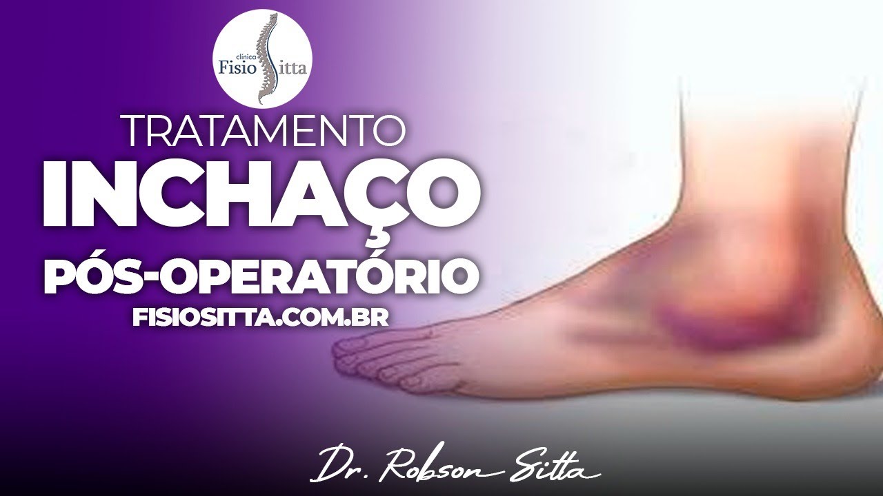 EDEMA INCHAÇO PÓS TRAUMA FRATURA IMOBILIZAÇÃO CONTUSÃO Clínica de Fisioterapia Dr. Robson Sitta