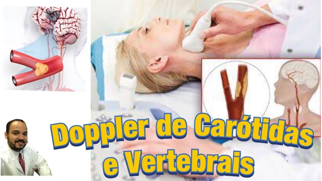 Ultrassonografia Doppler de Carótidas e Vertebrais - Exame e Diagnósticos