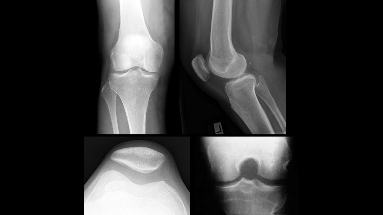 Rx do Joelho: Anatomia