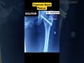 Neck Femur Fracture  | Problem Vs Solution | #femur #fracture