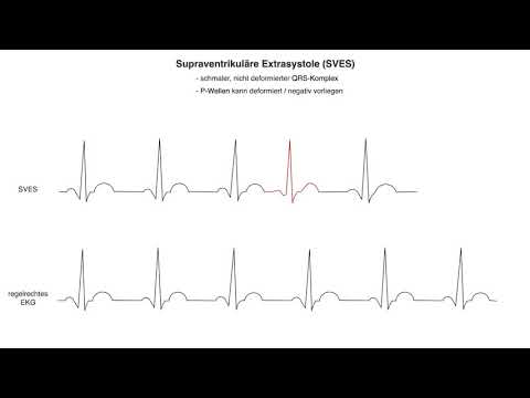 Supraventrikuläre Extrasystole (SVES) www.clipdocs.de