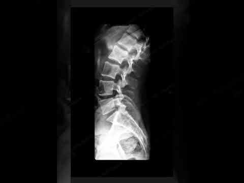 LS Spine X-Ray Views: AP, Lat, and Oblique Explained #Radiology #LSspine #XRayimaging