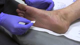 Semmes Weinstein Test for Diabetic Neuropathy and Nerve Problems