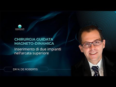 Dr. De Robertis - Due impianti arcata superiore con chirurgia guidata magnetodinamica