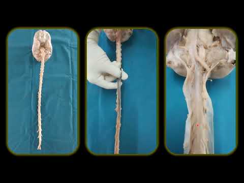 Cadaveric Brain & Spinal Cord Removal (with Meninges)