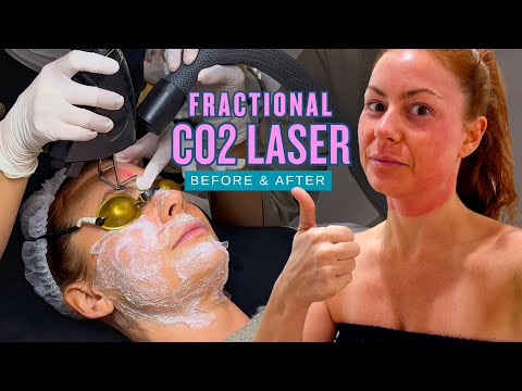 Most Powerful Anti-Aging Laser? My Fractional CO2 Laser Review! (Before & After)