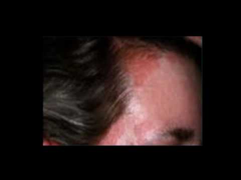 comment traiter eczema cuir chevelu