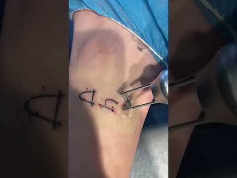 , title : 'PicoPlus Laser Tattoo Removal Procedure with Roy Geronemus, M.D.'